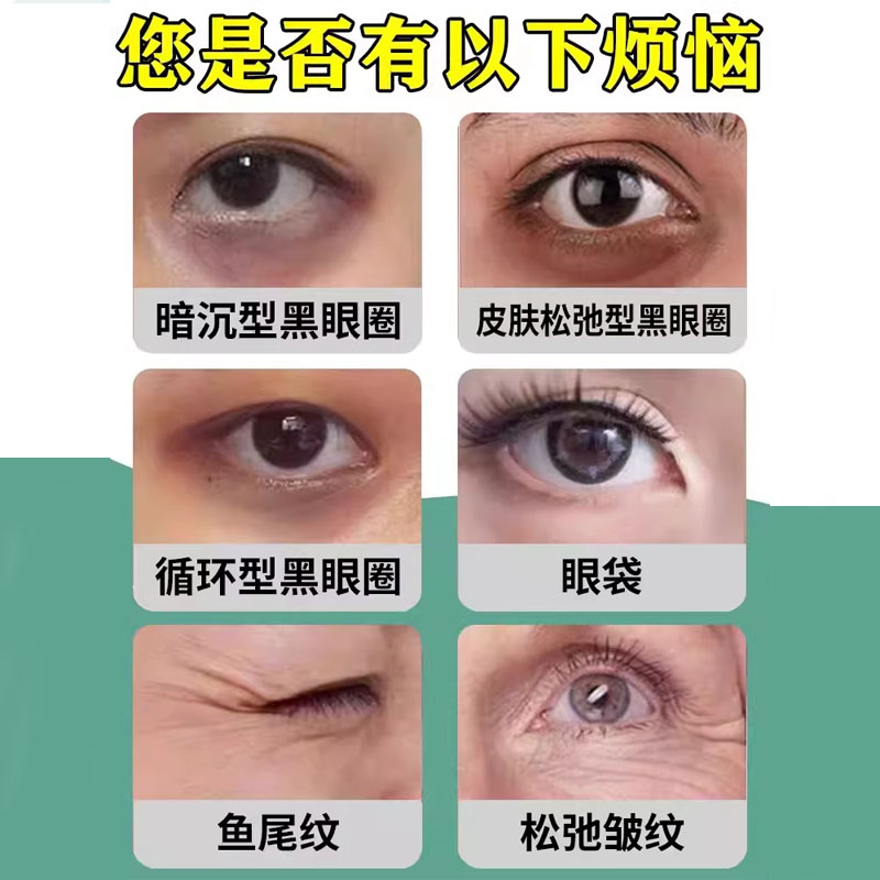 黑眼圈是肾虚还是肝虚导致的呢？