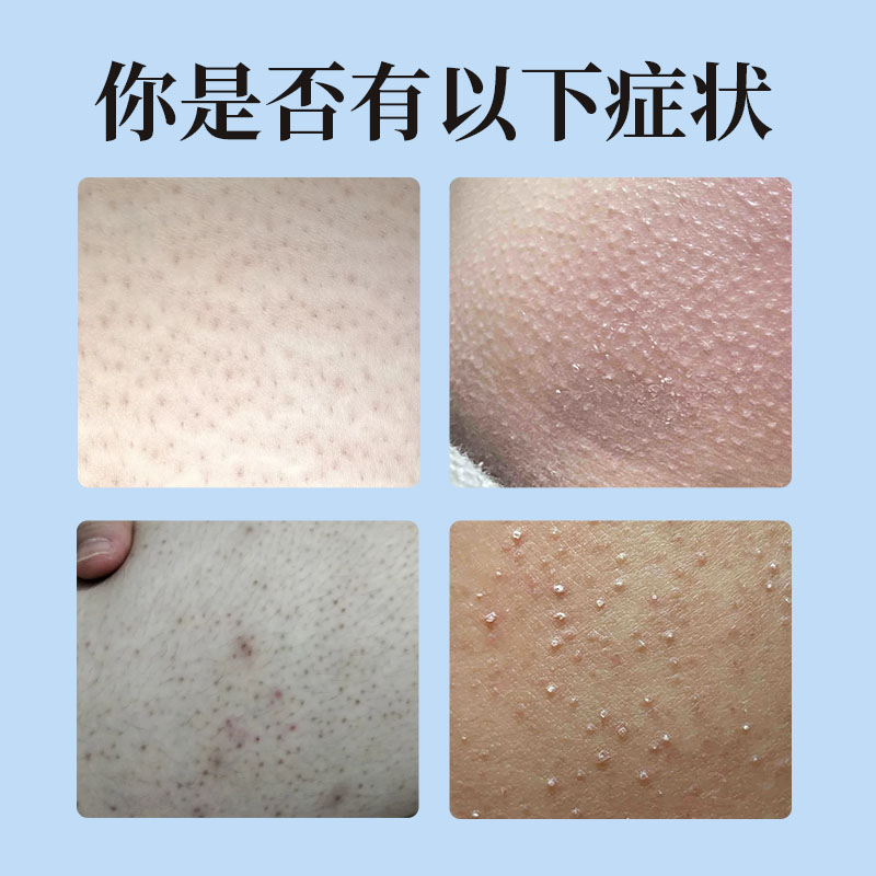 为什么屁股皮肤会变得粗糙？如何改善这一问题？