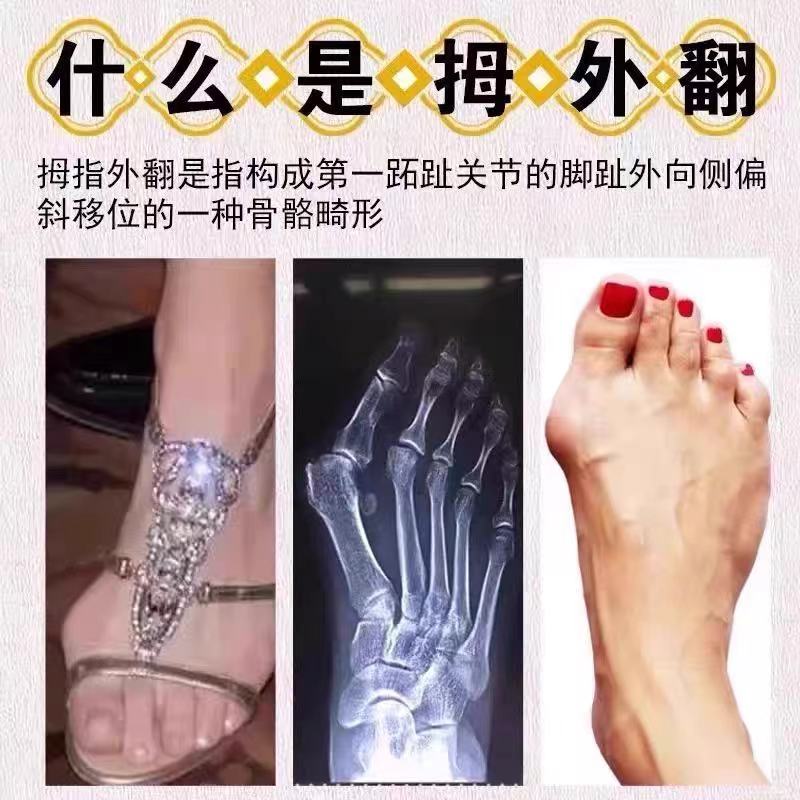 【100%矫正好】拇外翻贴脚趾重叠防磨大脚骨外翻专用膏贴，告别疼痛，轻松矫正！