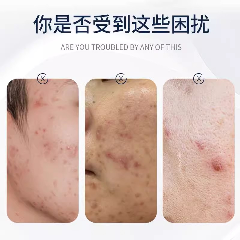 roohoo湿膏疹融禾皮肤修护凝胶：告别皮炎痤疮，重拾肌肤自信
