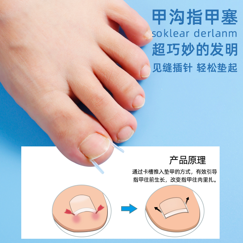 日本正甲贴：告别嵌甲烦恼，重塑完美脚趾！✨