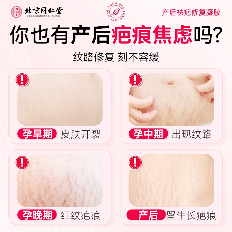 妊辰纹可以修复好吗？产后妈妈的美丽救赎
