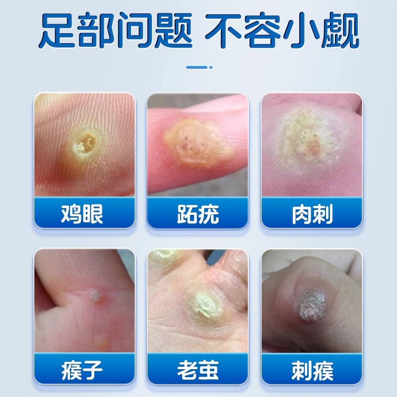 BUZO倍清祛疣膏：告别疣烦恼，轻松拥有光滑肌肤的秘密武器！