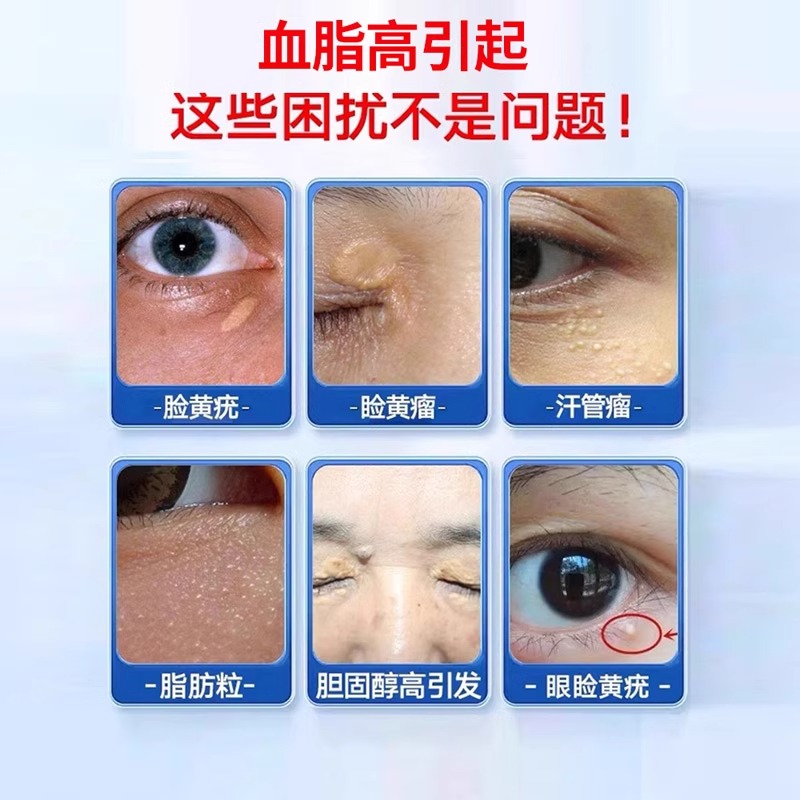 眼周黄褐斑怎么去掉？有效改善方法大揭秘！