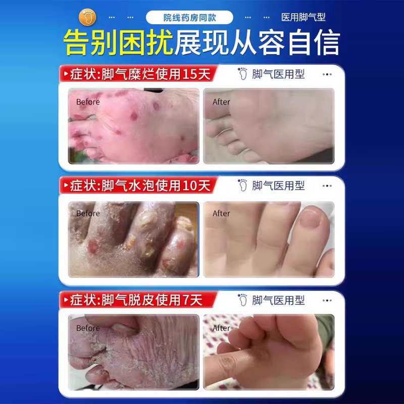 日本技术特效脚气喷雾：告别脚臭，清爽一夏！