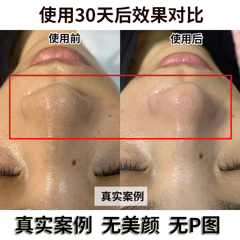 去黑头鼻贴收缩毛孔粉刺闭口深层清洁神器，草莓鼻膜三件套男女通用，肌肤焕新就靠它！