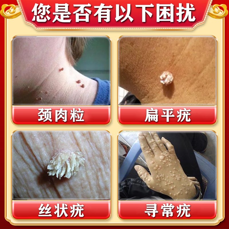 马应龙水杨酸软膏：丝状疣小肉粒克星，脖子上的烦恼终结者！