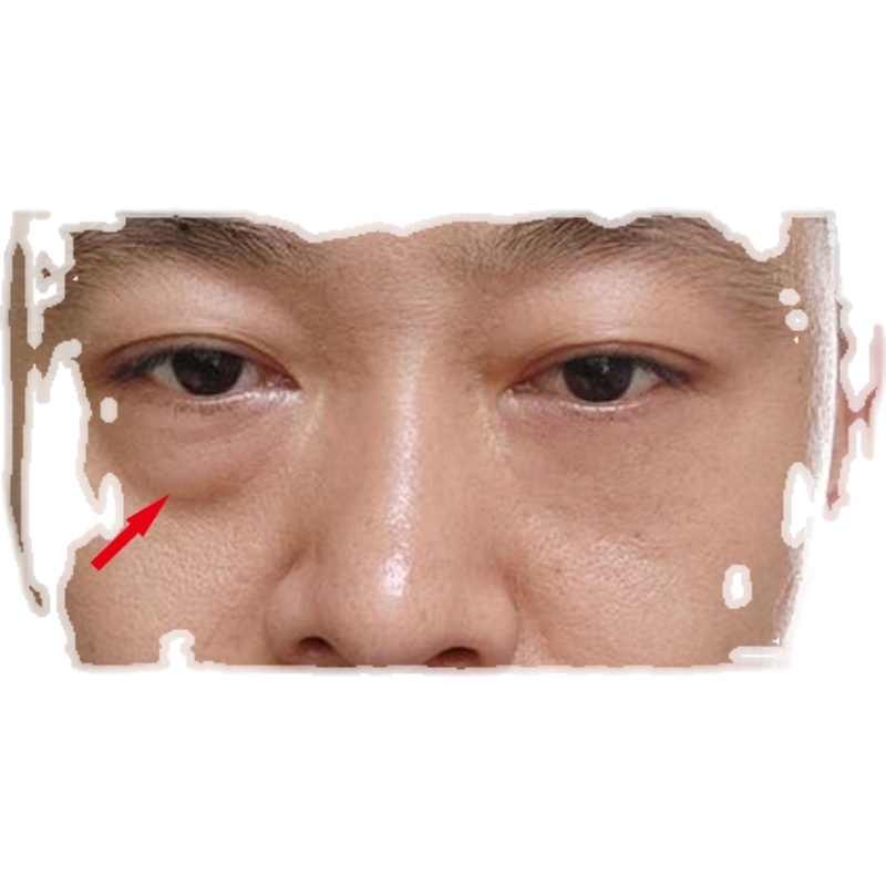 一般鱼尾纹和细纹会在什么年龄开始长？如何预防？