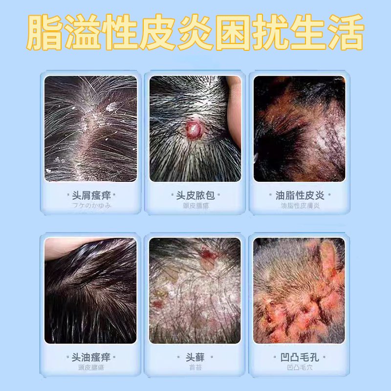 小孩头皮屑一大块一大块是什么原因？如何解决?