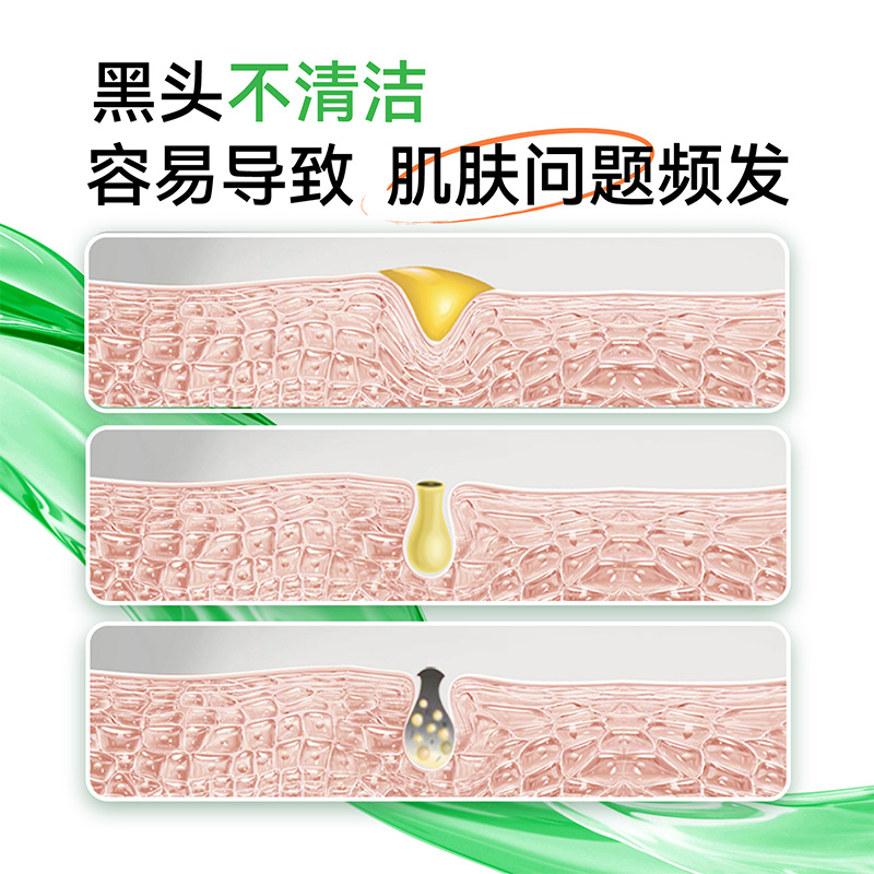 周年庆狂欢！黑头导出液30毫升3瓶仅需61.5元，速来抢购！