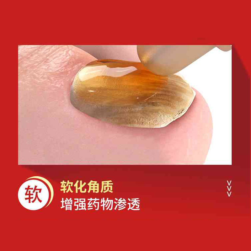 复方聚维酮碘搽剂：亮甲灰指甲的非专用药，官方旗舰店正品保障
